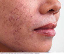 Load image into Gallery viewer, Clear Skin Face Wash/Acne/Combination (240 ml)