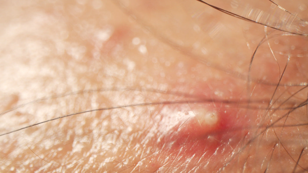 Oil Be gone Toner /Acne (150Ml)